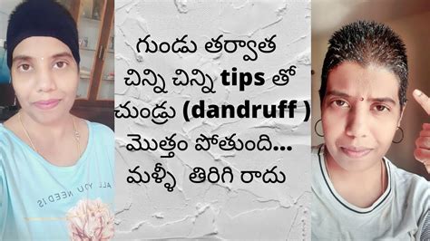 How To Treat Dandruff After Headshave In Telugu Headshave And Dandruff