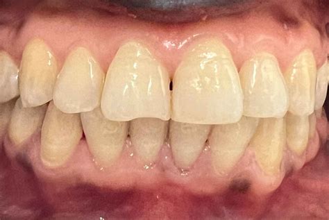 Melanosis Gingival Badia Cl Nica Dental