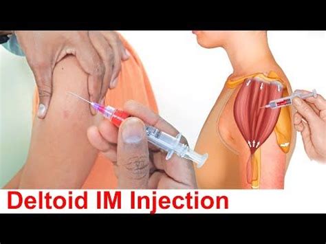 Deltoid Muscle Injection