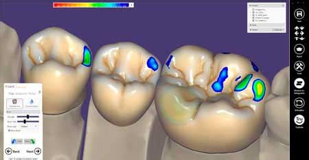 Exocad Dental Cad Prótesis fija 3D