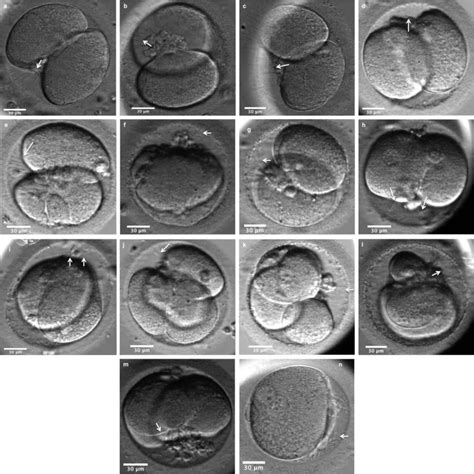 Perivitelline Threads Associated With Fragments In Human Cleavage Stage Embryos Observed Through