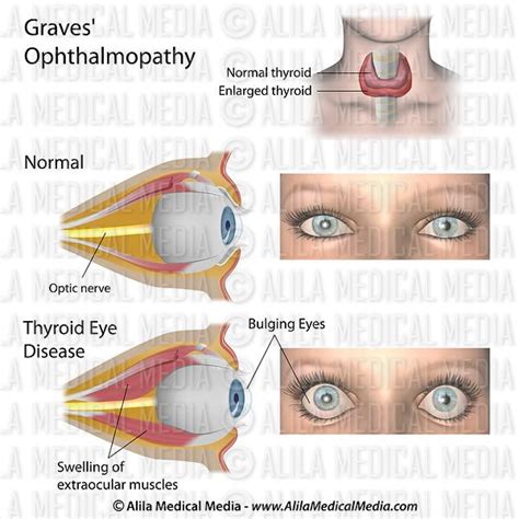 Alila Medical Media Thyroid Eye Disease Medical Illustration