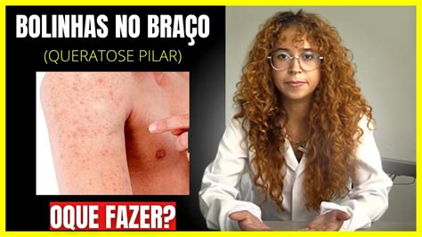 Como Combater E Tratar As Bolinhas No Bra O Queratose Pilar