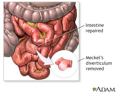 Meckel S Diverticulectomy Series