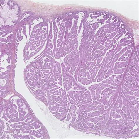 Mucinous Ovarian Carcinoma With An Expansile Pattern Displaying Nuclear