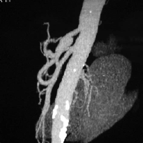 Angiotomografia ausência de dissecção aórtica Download Scientific