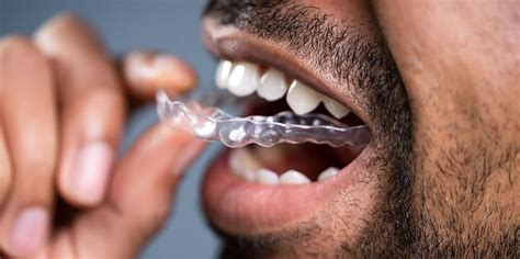 Invisalign Clear Braces Do They Really Work Md Periodontics