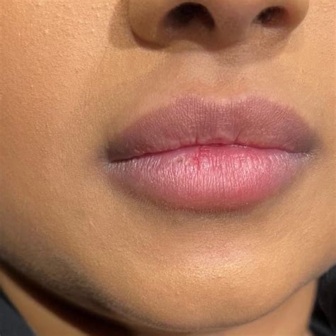 Lip Filler Dissolving Treatment Using Hyalase Hyaluronidase In London