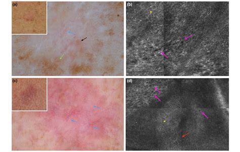 Dermoscopy And Reflectance Confocal Microscopy Of Solitary Flat Pink