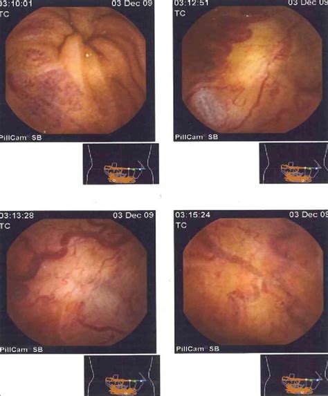 Capsule Enteroscopy Several Dilated Veins Visible In Mucosa Of The