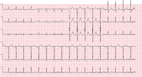 Potassium Imbalance Ekg