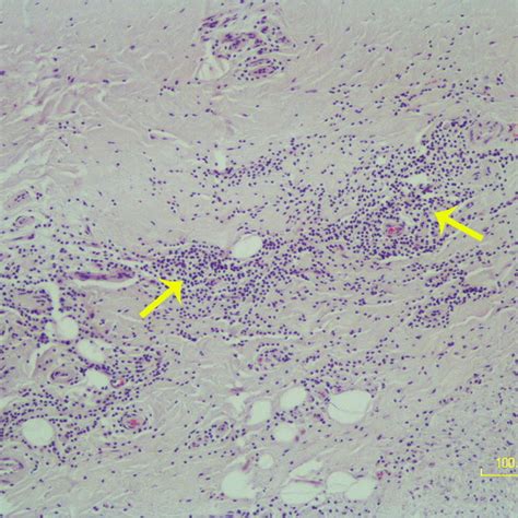 Infiltration Of Mononuclear Inflammatory Cells Arrows In The Dermis Download Scientific