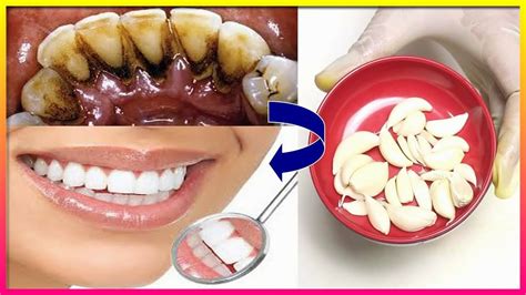 Teeth Whitening At Home In 3 Minutes How To Naturally Whiten Your Yellow Teeth 100 Work At