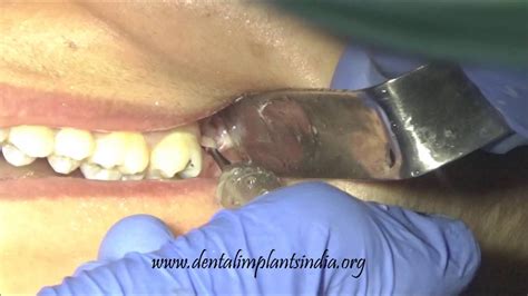 Deeply Impacted Upper Wisdom Molar Surgical Removal Video Youtube