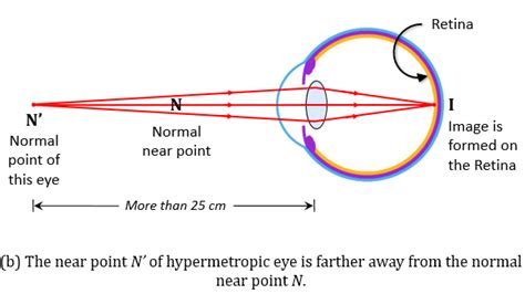 Where Is The Near Point Of A Person Suffering From Tutorix