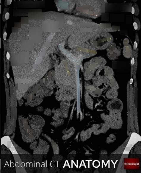 Abdominal Ct Coronal Diagram Diagram Quizlet