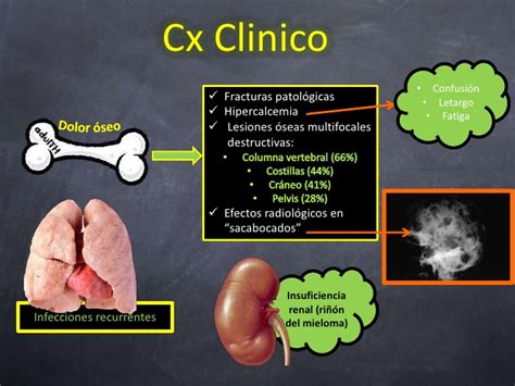 Plasmocitoma Definici N S Ntomas Tratamiento Y Mucho M S