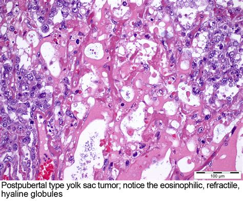 Pathology Outlines Yolk Sac Tumor