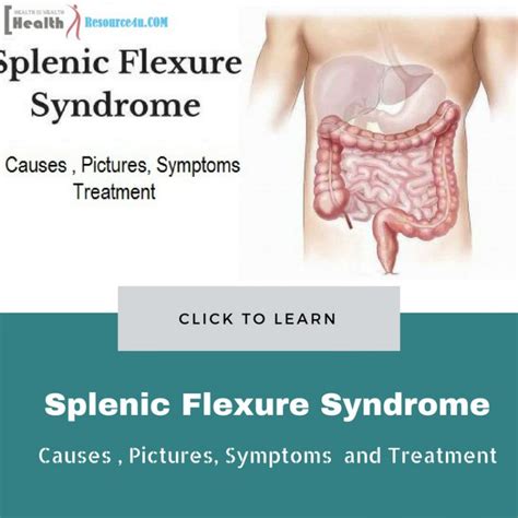 splenic flexure syndrome symptoms pregnant center informations