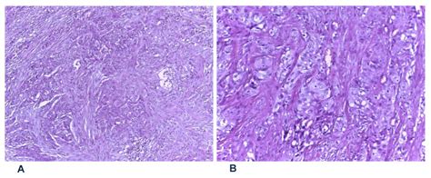 Pharyngolaringeal Neoplasm Treated With Surgery And Radiotherapy