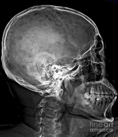 Multiple Myeloma Of The Skull Photograph By Rajaaisya Science Photo Library Fine Art America