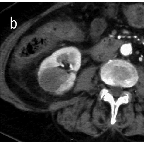 A Arterial Phase Of Contrast Enhanced Computed Tomography Ce Ct 3