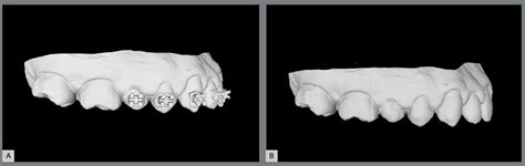 Scielo Brasil Orthodontic Digital Workflow Devices And Clinical