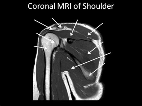 Coronal MRI Of Shoulder Diagram Quizlet