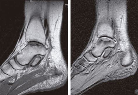 Fractura Osteocondral De La Cúpula Astragalina Medicina General Y De