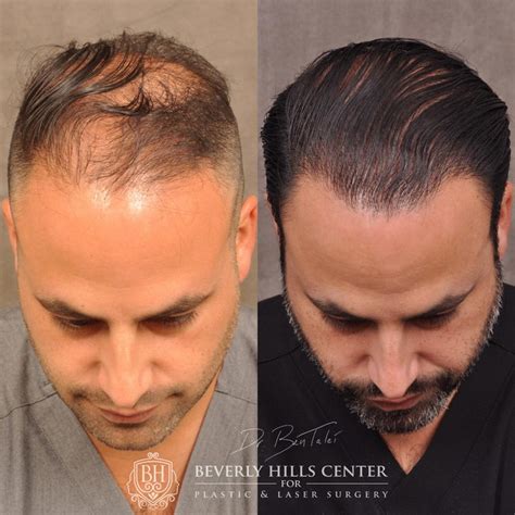 Hair Transplant And Hairline Lowering Before And Afters Beverly Hills Center