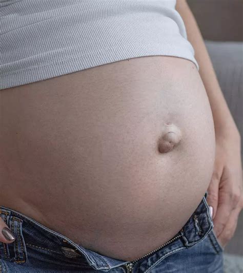 What Causes Umbilical Hernia In Pregnancy And How To Treat It