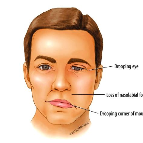 Proposed Algorithm For The Management Of Severe Bells Palsy Fp