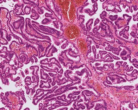 Pathology Outlines Choroid Plexus Tumors Papilloma Atypical