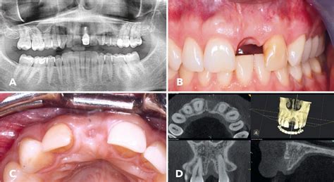 Figure From First Clinical Case Report Of A Xenograftallograft