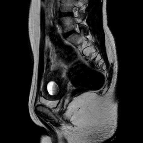 Unicornuate Uterus With Hematometra In Non Communicating Contralateral