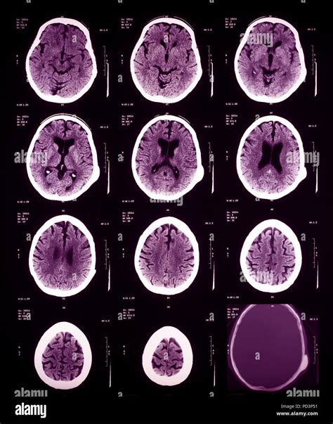 Sequence Of Horizontal Sections Of A Female Human Brain Mri Scans