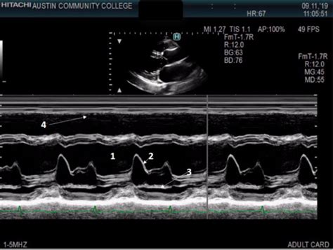 Principles Of Adult Echocardiography Test 1 And Final Flashcards Quizlet