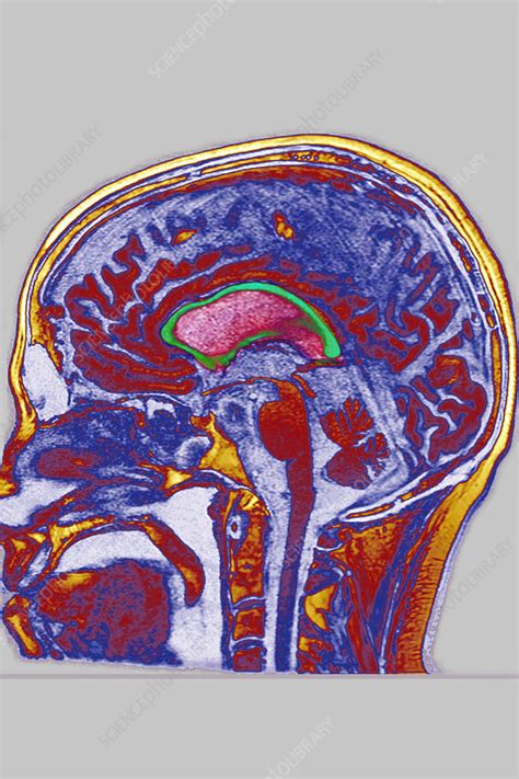 Cerebral atrophy, MRI - Stock Image - C044/8807 - Science Photo Library