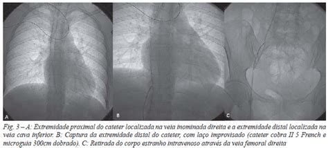 Scielo Brasil T Ticas E T Cnicas Endovasculares Para Retirada De