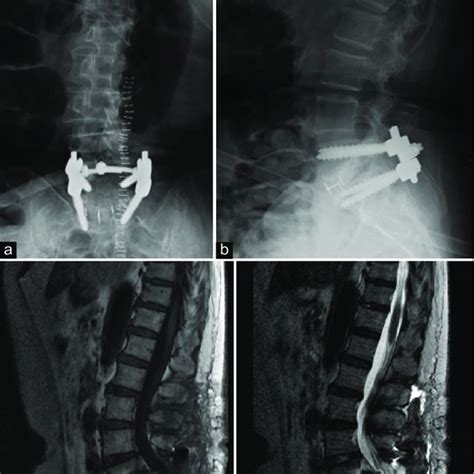 Anteroposterior A And Lateral B Radiographs Of The Lumbar Spine