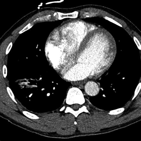 CTA chest performed as per pulmonary embolism protocol | Download ...