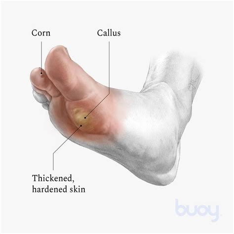 Understand Callus Treatment, Symptoms, Causes And Prevention PediFix ...