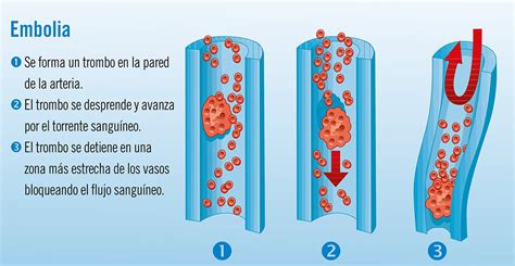 Embolia S Ntomas Y Tratamiento