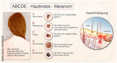 Hautkrebs Melanom Abcde Stock Illustration Adobe Stock