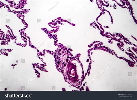 Histopathology Lung Emphysema Light Micrograph Photo Stock Photo