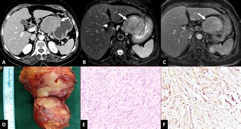 Gastric Schwannoma Year Old Female Presenting With Abdominal