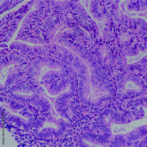 Camera Photo Of Atypical Endometrial Hyperplasia Showing Endometrial