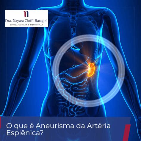 O Que Um Aneurisma Tratamento De Aneurismas Cerebrais Sem