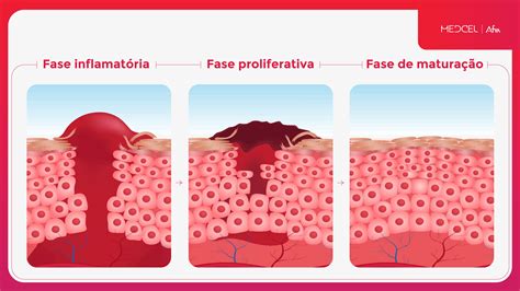 Fases Da Cicatrização De Feridas