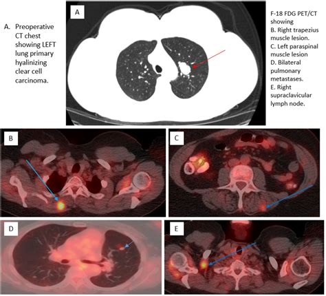 Evaluation Of Metastatic Hyalinizing Clear Cell Carcinoma Of The Lung